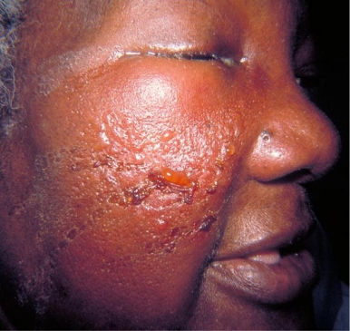 A 37-year-old female diabetic presented as seen in the image provided. The physician described the affected facial area as shiny, raised, hardened, and tender with a distinct margin. Which of the following organisms is most likely the causative agent?   Source: CDC/Dr. Thomas F. Sellers/Emory University A)  Catalase-negative, bacitracin-susceptible, gram-positive coccus B)  Catalase-positive, coagulase-positive, gram-positive coccus C)  Oxidase-positive, gram-negative rod that produces a blue-green pigment and a grape-like odor D)  Fungus