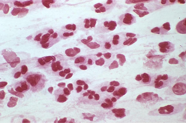 On a hot day in July, an unresponsive 15-year-old male presents with a stiff neck and fever. A cerebrospinal fluid is sent to the microbiology department for routine culture and Gram stain. The results of the direct Gram stain are provided.   Source: CDC and Dr. Norman Jacobs Which of the following organisms can account for these Gram stain results? A)  Neisseria meningitidis B)  Mycobacterium tuberculosis C)  Naegleria fowleri D)  Herpes simplex virus