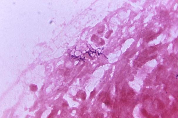 <strong>A 28-year-old male has had his wisdom teeth removed. Two weeks after the procedure, he develops swelling along the right jaw line in the area where his wisdom teeth were removed. His physician aspirates a pocket of pus within the jaw. The direct Gram stain of the aspirate is demonstrated in the image provided.   Source: CDC This organism is known for the production of</strong> A) double beta hemolysis. B) dental caries. C) a Medusa head colony. D) sulfur granules. <div style=padding-top: 35px> 