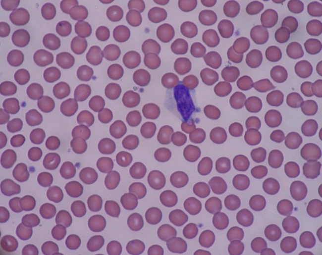 The peripheral blood smear cell observed, in the image provided, is known as a   Source: Bobjgalindo A)  neutrophil. B)  reactive lymphocyte. C)  plasma cell. D)  monocyte.