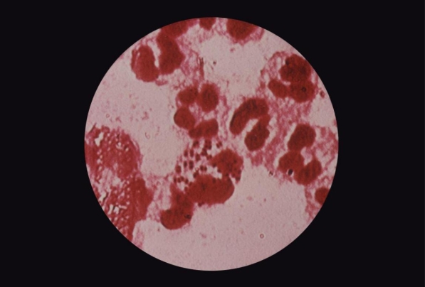 A 17-year-old male presents to the emergency room lethargic with a fever and rash. Blood cultures and cerebrospinal fluid samples are taken. The direct Gram stain of the CSF is provided.   Source: CDC and Susan Lindsley At 24 hours, the blood cultures and CSF culture grow the same organism. Testing Results include: Gram stain: same as the direct smear Oxidase: purple Glucose and maltose fermentation tubes: yellow Lactose and sucrose fermentation tubes: red Butyrate esterase: no color change After a thorough history was taken with the assistance of the parents, it was Discovered the patient has had two similar disease episodes in the past two years with The same organism. The physician should test the patient for A)  a deficiency of the classical pathway of the complement system. B)  a deficiency of the common terminal pathway of the complement system. C)  common variable immune deficiency. D)  severe combined immunodeficiency.