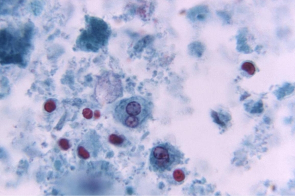 Review the image provided of a trichrome stained fecal specimen.   Source: CDC How is the structure in the center of the image best distinguished from an amoeba? A)  The image is an amoeba. B)  The nuclear material: cytoplasm ratio is smaller in human cells. C)  The nuclear material: cytoplasm is greater in human cells. D)  White blood cells usually only have one nucleus.
