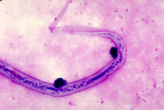 An astute hematologist notes the organism in the image provided on a stained blood smear.   Source: CDC/Dr. Mae Melvin She calls you over to confirm its identification. She asks what disease is associated with this organism. You tell her A)  river blindness. B)  visceral larval migrans. C)  elephantiasis. D)  Calabar swellings.