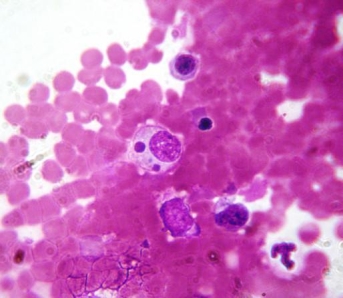 A 25-year-old male had been hiking in Southeast Missouri. He presented to his physician with headache, fever, and myalgia. He noted in his history many tick bites on his legs. The physician suspected Rocky Mountain spotted fever, but the serology proved to be negative and the patient did not have a rash. Routine culture of blood and bone marrow were negative. An observant medical laboratory scientist in the hematology department noted an unusual inclusion on the stain of the patient's bone marrow smear as seen in the image provided.   Source: Filipe Dantas-Torres Based on this additional finding, the physician should now suspect A)  Anaplasma phagocytophilum. B)  Ehrlichia chaffeensis. C)  Rickettsia rickettsii. D)  Chlamydia trachomatis.