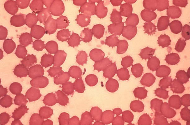 <strong>A set of blood culture bottles is drawn. At 48 hours, the anaerobic bottle is positive with the organism in the image provided.   Source: CDC and Dr. Jack Poland You would subculture this positive blood culture bottle to 1) sheep blood agar. 2) chocolate agar. 3) MacConkey agar. 4) phenylethyl alcohol agar. 5) reducible blood agar</strong> A) 1, 2, 3, and 5 B) 2, 3, 4, and 5 C) 1, 3, 4, and 5 D) 1, 2, 3, and 4 <div style=padding-top: 35px> 