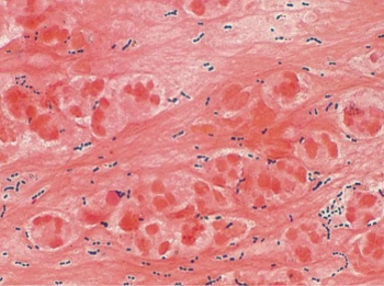 A 82-year-old female is hospitalized with pneumonia. The image provided is the direct Gram stain of her sputum.   The sputum culture, after 48 hours incubation, reveals: Moderate growth of Enterobacter aerogenes Light growth of normal upper respiratory flora</UL> Based on all information obtained, you determine A)  the results are accurate. B)  the direct Gram stain slide was under-decolorized. C)  there are discrepant results. D)  this is a case of hospital-acquired pneumonia.