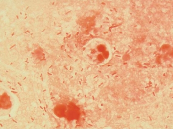 A comatose 28-year-old male was hospitalized three days ago due to head trauma after a motorcycle accident. He has been on a ventilator since admission. He has developed a fever. The physician orders blood, urine, and sputum cultures. The direct sputum Gram stain reveals the results noted in the image provided.   The blood and urine cultures are negative at 48 hours. The sputum culture grows a predominance of Klebsiella pneumoniae with no normal upper respiratory flora present. This patient's infection Is probably due to A)  aspiration pneumonia. B)  ventilator-associated pneumonia. C)  hospital-acquired pneumonia. D)  all of the above.