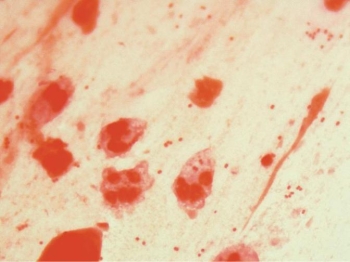 A 92-year-old male is hospitalized with community-acquired pneumonia. The image provided is the direct Gram stain of his sputum.   The sputum culture, after 48 hours incubation, reveals: Moderate growth of small  hockey puck  colonies that produce a blue-green Butyrate esterase result Light growth of normal upper respiratory flora Based on all information obtained, you report moderate growth of A)  normal upper respiratory flora. B)  Moraxella catarrhalis. C)  Neisseria meningitidis. D)  Neisseria gonorrhoeae.