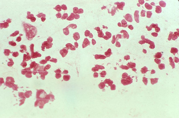 <strong>Catheterized urine from a 49-year-old female was submitted for Gram stain and culture. The image provided demonstrates the Gram stain of one drop of the urine at 1000X magnification.   Source: CDC and Dr. Normal Jacobs Determine the expected bacterial colony count based on these results.</strong> A) >10<sup>2</sup> CFU/mL but <10<sup>5</sup> CFU/mL B) >1000 organisms/mL but < 100,000 organisms/mL C) >10<sup>5</sup> CFU/mL D) 10,000 - 50,000 organisms/mL <div style=padding-top: 35px> 
