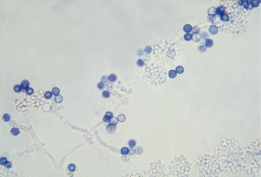 <strong>Thirty colonies of a white creamy isolate were noted at 24 hours on the sheep blood agar of a catheterized urine culture from a 53-year-old male hospitalized for a ruptured appendix. The MacConkey agar showed no growth. The agars were inoculated using a 0.01 mL calibrated loop. On further testing, the white colony produced the results observed in the image provided.   Source: CDC/Dr. Godon Roberstad This organism should be reported as</strong> A) 300 colonies/mL of yeast not Candida albicans. B) 300 colonies/mL of Candida glabrata. C) 3000 colonies/mL of Candida glabrata. D) 3000 colonies/mL of Candida albicans. <div style=padding-top: 35px> 