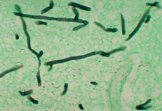 Identify the structure the image provided.   Source: CDC and Dr. Libero Ajello A)  Hyaline septate hyphae B)  Dematiaceous septate hyphae C)  Hyaline aseptate hyphae D)  Dematiaceous aseptate hyphae