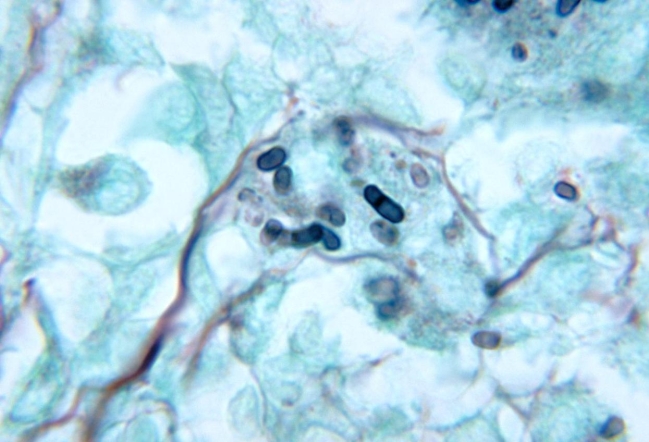 A recent female immigrant from Vietnam presents to the emergency room with fever and numerous lesions on her skin. Her history is significant because she is HIV positive. The physician draws blood cultures and takes a bone marrow sample for routine and fungal culture. At 48 hours, the routine cultures demonstrate no growth. At three days, the room temperature fungal agar shows a velvety, red-white colony that exhibits a maroon pigment in the agar around the colony. The 35°C fungal agar shows small white moist colonies. The microscopic morphology of the 25°C colony is provided.   Source: CDC, Dr. Lucille K. George, and Dr. Arthur DiSalvo Which of the following organisms is the possible etiologic agent? A)  Aspergillus fumigatus B)  Histoplasma capsulatum C)  Sporothrix schenckii D)  Penicillium marneffei