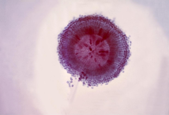 A 21-year-old female leukemia patient receiving chemotherapy develops fever, cough, chest pain, and trouble breathing. A sputum culture is submitted for routine, fungal, and acid-fast cultures. At 48 hours, a black filamentous mould is growing on the sheep blood and chocolate agars. The fungal culture is growing the same organism. Microscopic examination of the organism is provided in the image below.   Source: CDC and Dr. Lucille K. Georg Which organism is causing her infection? A)  Penicillium spp. B)  Aspergillus fumigatus C)  Aspergillus niger D)  Mucor spp.