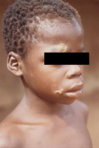 A 10-year-old male from Africa presents with skin lesions as seen in the image provided.   Source: CDC and Dr. Peter Perine The lesions demonstrate spirochetes on darkfield examination. The treponemal Serologic tests are also positive. You suspect the infection is due to A)  Treponema pallidum ssp. pallidum. B)  T. pallidum ssp. endemicum. C)  T. carateum. D)  T. pallidum ssp. pertenue.