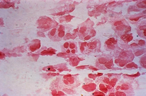 A 30-year-old male sees his physician complaining of urinary frequency and burning. A urine and swab of penile discharge were submitted for culture and Gram stain. Review the Gram stain image of the penile discharge. What can be deduced from the penile Gram stain?   Source: CDC and Joe Miller A)  The patient has gonorrhea. B)  The patient probably has a urinary tract infection. C)  There is no need to culture the penile discharge based on the Gram stain. D)  A chocolate agar should be added to the urine culture.