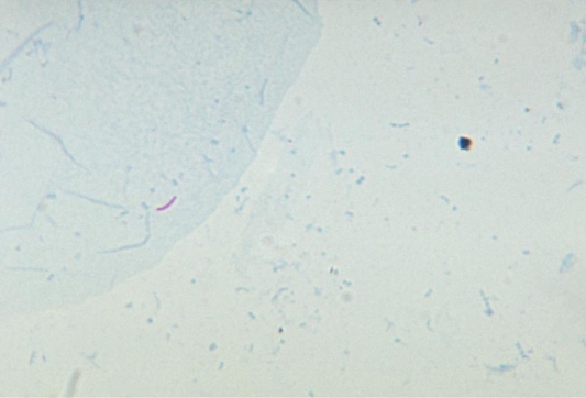 <strong>Using the image provided and knowing the primary stain used was not heated after application, one can determine this slide depicts a   Source: CDC and Ronald W. Smithwick</strong> A) positive Kinyoun reaction. B) positive Ziehl-Neelsen reaction. C) negative Kinyoun reaction. D) negative Ziehl-Neelsen reaction. <div style=padding-top: 35px> 