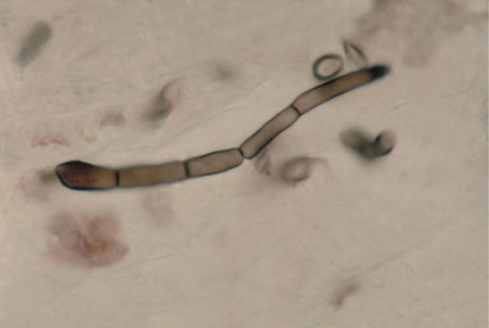 Using the image provided, the fungal element observed is described as   Source: CDC and Dr. Libero Ajello A)  a germ tube. B)  dematiaceous septate hyphae. C)  hyaline aseptate hyphae. D)  conidiophores.