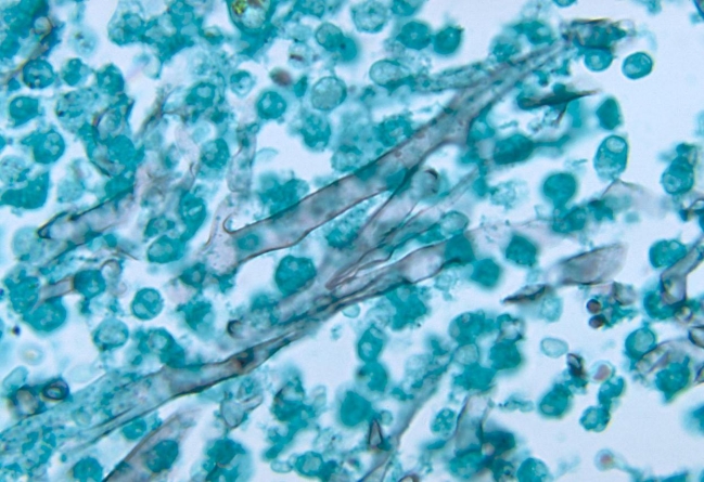 Using the image provided, the fungal element observed is described as   Source: CDC and Dr. Libero Ajello A)  hyaline septate hyphae. B)  hyaline aseptate hyphae. C)  dematiacous septate hyphae. D)  dematiaceous aseptate pseudohyphae.