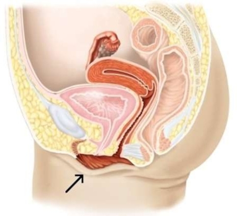 In this picture, the arrow is pointing to the   A)  vaginal orifice. B)  labia minora. C)  clitoris. D)  labia majora.