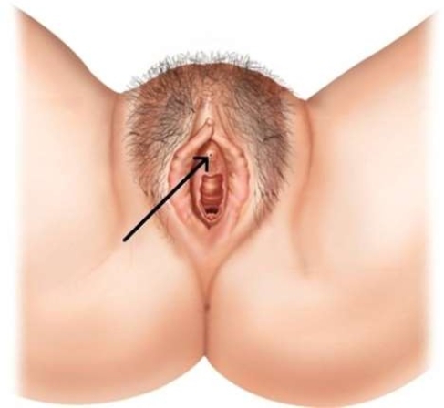 <strong>In the picture below, the arrow is pointing to the  </strong> A) clitoris. B) urethal opening. C) vestibule. D) labia minora. <div style=padding-top: 35px> 