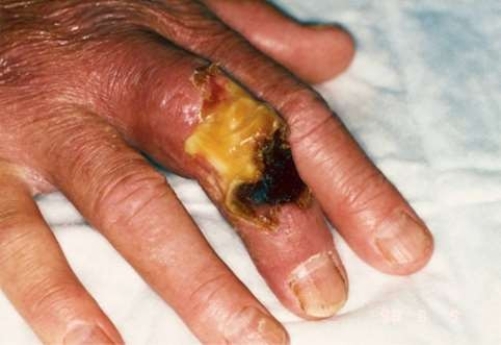 Which of the following statements is correct regarding this patient's condition?   A)  Initial signs and symptoms of this type of snake bite usually appear within 12 hours after the bite. B)  The signs and symptoms the patient may have experienced from this bite include vomiting and shock. C)  This type of snake bite most commonly occurs between the months of May and September. D)  The type of snake that bit this person has a tendency to inject its venom through chewing movements.