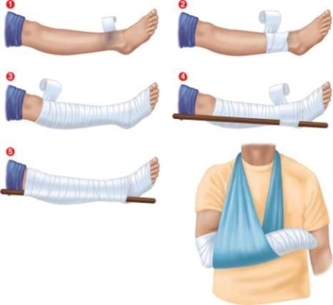 <strong>What type of snake bite should be treated with this immobilization technique?  </strong> A) Copperhead bite B) Water moccasin bite C) Rattlesnake bite D) Coral snake bite <div style=padding-top: 35px> 