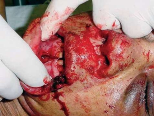 What statement is correct about this type of injury?   A)  Significant loss of blood is not a concern with this injury. B)  This injury may destabilize the position of the tongue. C)  Spinal stabilization is not always recommended for this injury. D)  Teeth lost in this injury must be handled by the root.