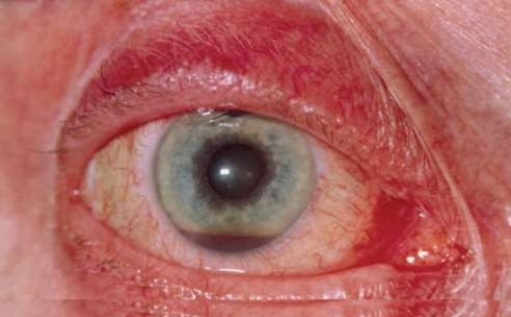 This type of sight-threatening injury is known as   A)  ligament collapse. B)  chamber leak. C)  hyphmea. D)  blepharitis.