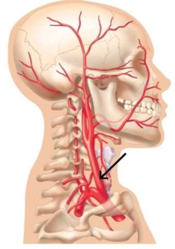 The structure which is referred to in this image, responsible for the arterial blood supply to the face, is the_________ carotid artery.   A)  superior B)  common C)  external D)  internal