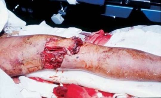 What does this picture show?   A)  An open tibia fracture. B)  A closed femur fracture. C)  An open femur fracture. D)  A closed tibia fracture.