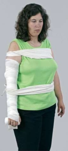 What does this image depict?   A)  A chest injury immobilized in a straight position. B)  An elbow injury immobilized in a straight position. C)  A forearm injury immobilized in a straight position. D)  A humerus injury immobilized in a straight position.