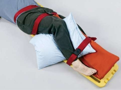 What does this image depict?   A)  Immobilization of a hip injury B)  Immobilization of a femur injury C)  Immobilization of an ankle injury D)  Immobilization of a lower leg injury