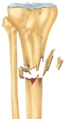 What type of fracture is pictured here?   A)  Comminuted B)  Open C)  Linear D)  Greenstick