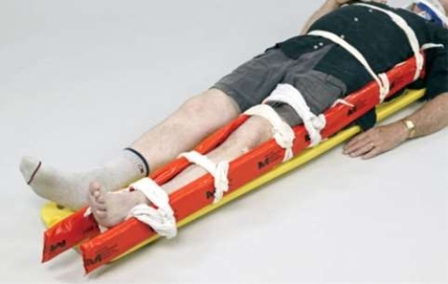 What does this image depict?   A)  Immobilization of a femur fracture B)  Immobilization of a pelvic fracture C)  Immobilization of a hip dislocation D)  Immobilization of an ankle injury