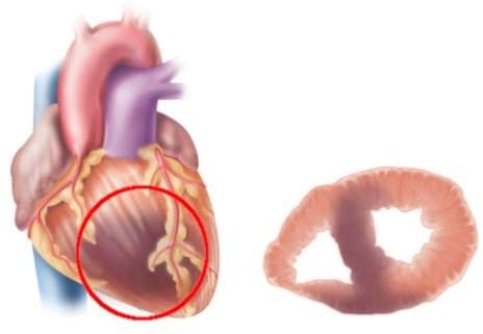 In this image, the dark red tissue of the heart illustrates   A)  myocardial contusion. B)  pulmonary contusion. C)  cardiac laceration. D)  pericardial effusion.