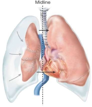 This displacement of the internal organs is called   A)  myocardial contusion. B)  tracheal deviation. C)  traumatic asphyxiation. D)  mediastinal shift.