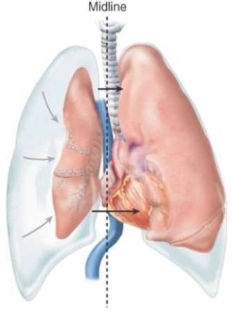 This image shows   A)  paradoxical movement. B)  mediastinal shift. C)  tracheal deviation. D)  pneumothorax.