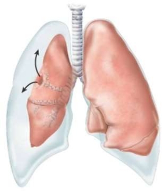 What condition does this image depict?   A)  Complex pneumothorax B)  Basic pneumothorax C)  Simple pneumothorax D)  Open pneumothorax