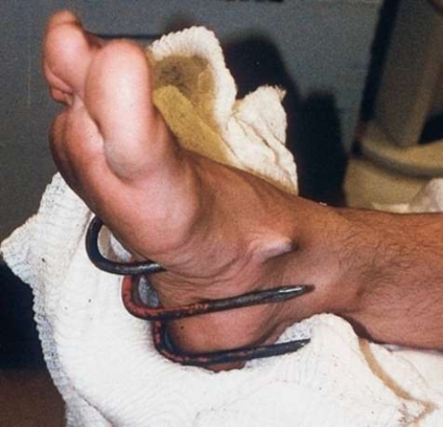 This puncture wound would most likely be at risk for   A)  compartment syndrome and hematoma. B)  external bleeding and hypovolemia. C)  crush syndrome and paralysis. D)  infection and internal bleeding.