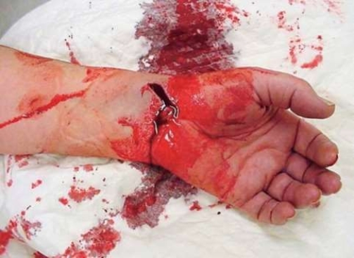 What type of injury is this?   A)  Puncture wound B)  Compound fracture C)  Laceration D)  Crush injury