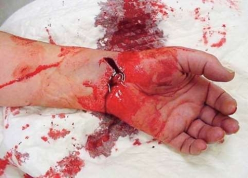 When treating this injury, you should first   A)  compress the brachial pressure point. B)  irrigate the wound. C)  elevate the limb. D)  apply direct pressure.