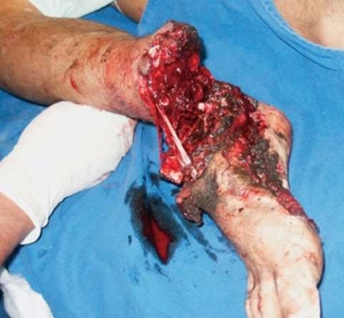 Explain the lack of blood in this amputation injury.   A)  The wound is cauterized and sealed. B)  The patient lost all blood volume from the wound. C)  The blood vessels constricted and pulled inward. D)  The blood has been stopped by a tourniquet.