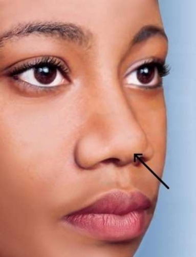 <strong>In this picture of the nose, the arrow is pointing to the </strong> A) dorsum nasi. B) ala nasi. C) anterior naris. D) alar nasal sulcus.