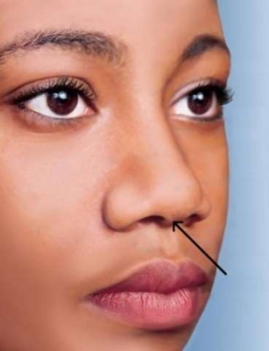 <strong>In the picture below, the arrow is pointing to the </strong> A) philtrum. B) alar nasal sulcus. C) anterior naris. D) nasal septum.