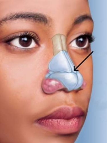 <strong>In the picture below, what is the name for the cartilage that the arrow is pointing to? </strong> A) Lateral B) Greater alar C) Septal D) Lesser alar