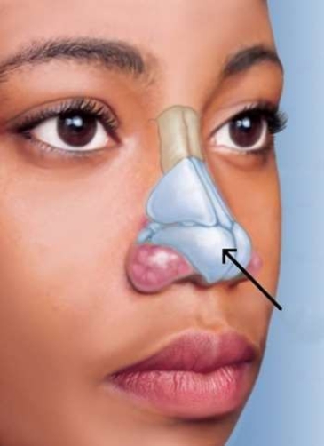 <strong>In the picture below, what is the name for the cartilage that the arrow is pointing to? </strong> A) Greater alar B) Lateral C) Lesser alar D) Septal