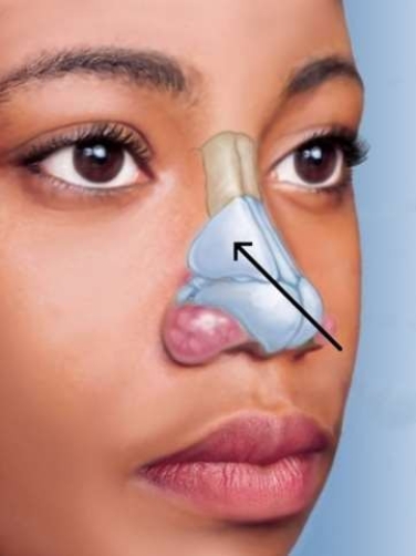 <strong>In the picture below, what is the name for the cartilage that the arrow is pointing to? </strong> A) Lateral cartilage B) Greater alar cartilage C) Lesser alar cartilage D) Septal cartilage