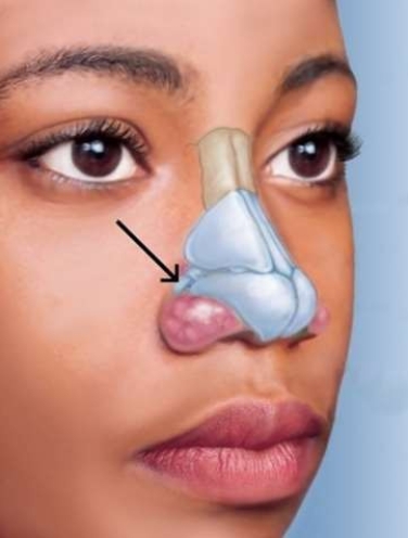 <strong>In the picture below, what is the name for the cartilage that the arrow is pointing to? </strong> A) Septal cartilage B) Lateral cartilage C) Lesser alar cartilage D) Greater alar cartilage