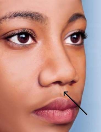 <strong>The skin between the nose and upper lip, indicated by the arrow in the picture below, is called the </strong> A) nasal septum. B) alar nasal sulcus. C) anterior naris. D) philtrum.