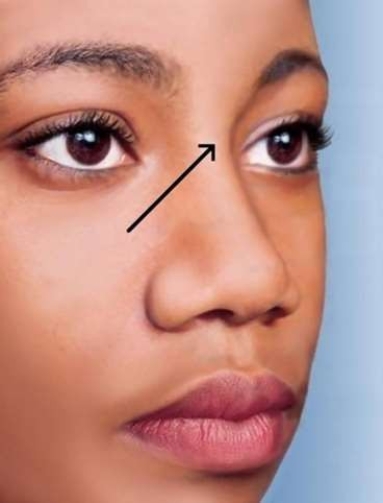 <strong>The upper part of the nose that falls between the eyes and is indicated by the arrow in the picture is called the </strong> A) root. B) dorsum nasi. C) bridge. D) apex.